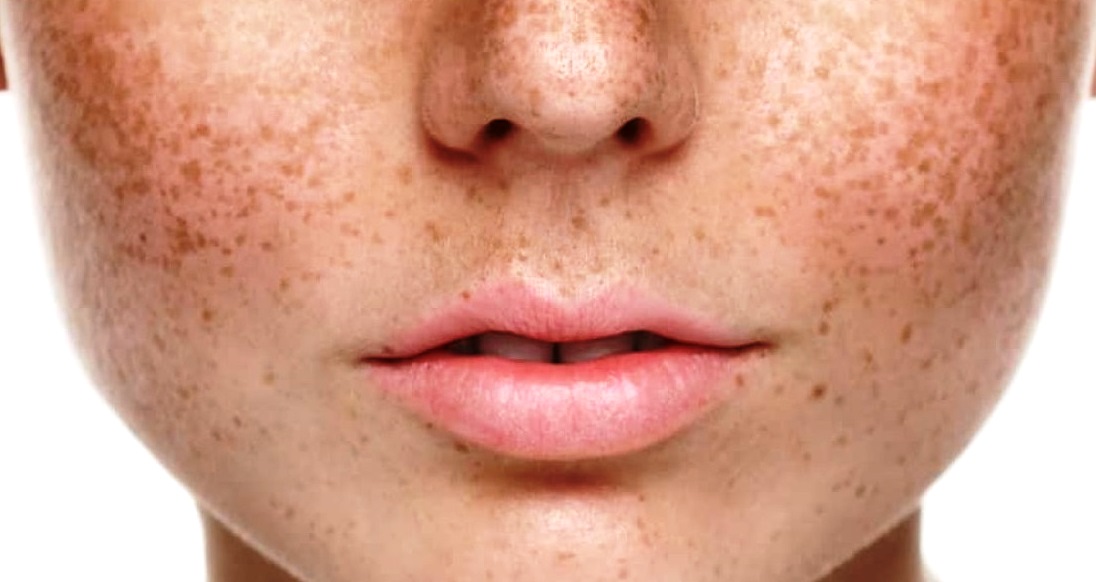 5 Cara Menghilangkan Bintik Hitam di Wajah dengan Bahan Alami