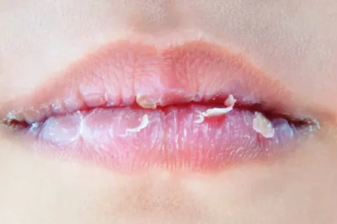 Tips Mengatasi Bibir Kering Dan Mengelupas Secara Alami Mudah Dilakukan