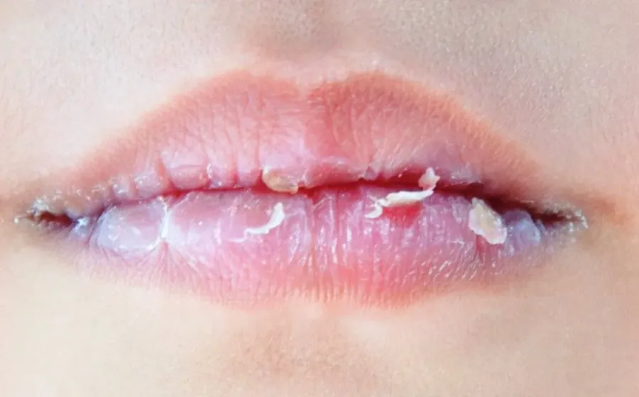 Tips Mengatasi Bibir Kering Dan Mengelupas Secara Alami Mudah Dilakukan