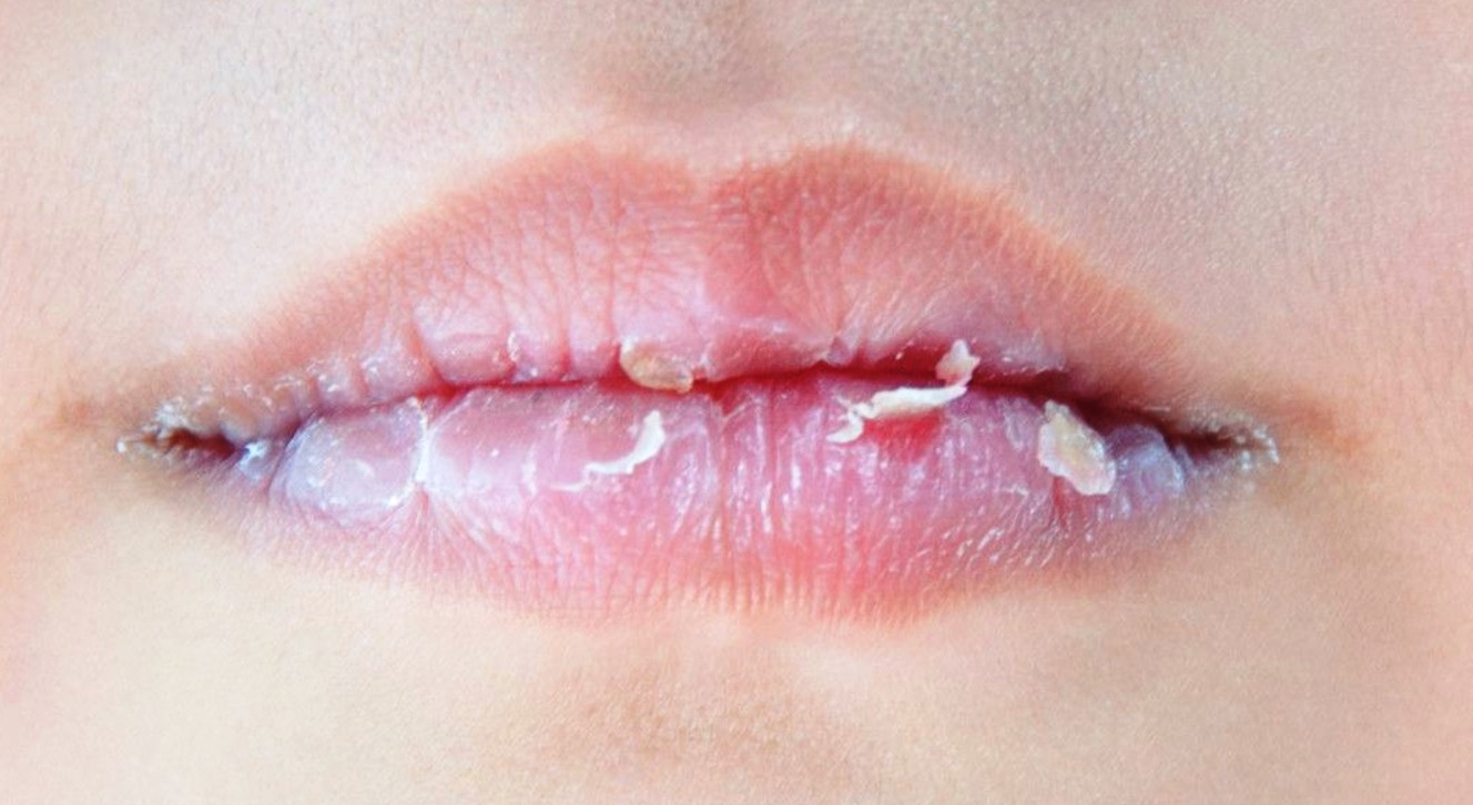 Tips Mengatasi Bibir Kering dan Mengelupas secara Alami Mudah Dilakukan