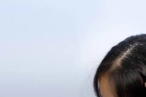 Tips Mengatasi Ketombe Yang Mengganggu Dengan Mudah Dan Ampuh