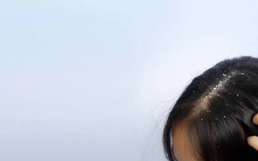 Tips Mengatasi Ketombe Yang Mengganggu Dengan Mudah Dan Ampuh