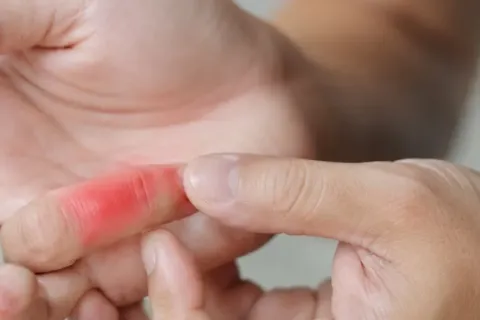 Solusi Cepat Atasi Cedera Jari Tangan Di Rumah